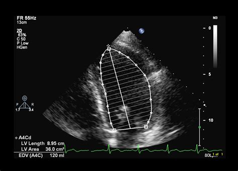 what is lvef in echocardiogram